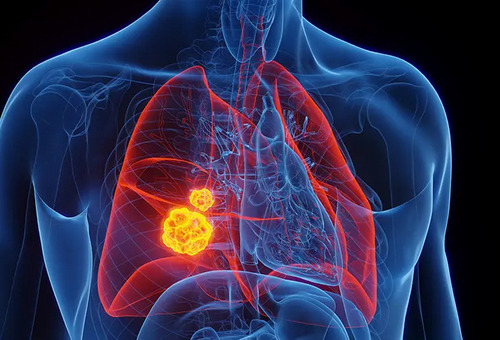 Harnessing the immune system in lung cancer: emerging role of the microbiome